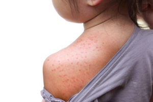 Rashes/Hives, Skin Cancer South Florida